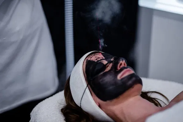 Spectral Peeling Laser Black Doll: Hannover's Radiant Skin Secret